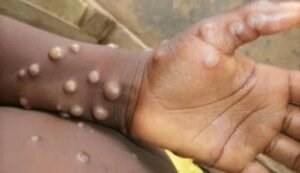 Kankan / Virus Mpox : « Nous sommes sous la menace » estime le Directeur Préfectoral de la Santé