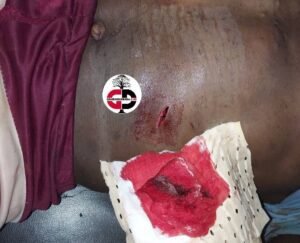 Doko (siguiri) : un conducteur de taxi-moto agressé et poignardé par ses passagers.