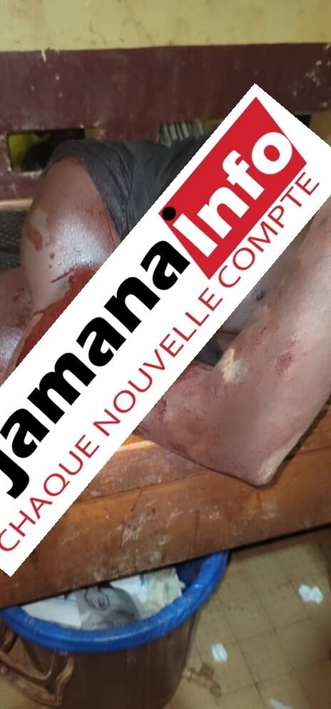 Siguiri : un jeune burkinabè grièvement blessé lors d’une attaque armée à Sèkè Madilah 1 Siguiri : un jeune burkinabè grièvement blessé lors d’une attaque armée à Sèkè Madilah