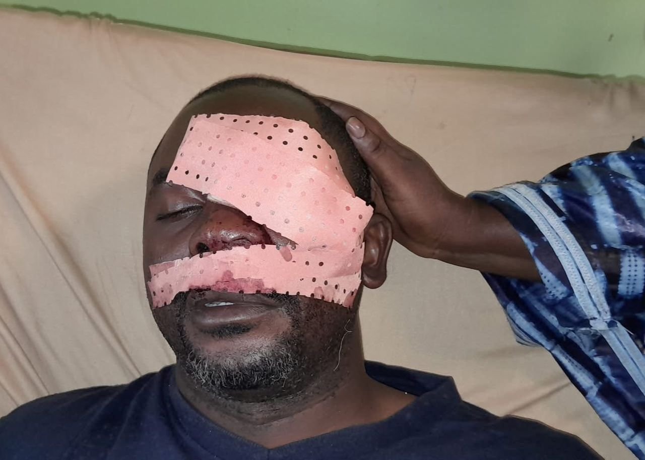Un journaliste de la RTG violemment agressé à Conakry : il perd l’usage de son œil gauche 1 Un journaliste de la RTG violemment agressé à Conakry : il perd l’usage de son œil gauche