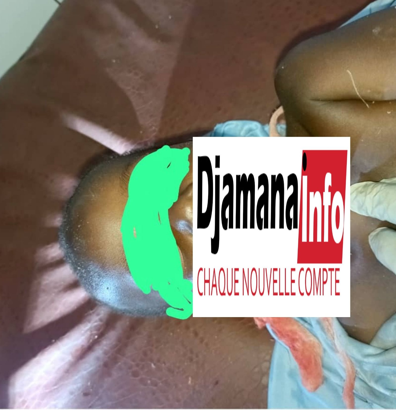 Siguiri : un enfant de 4 ans retrouvé égorgé à Bouré-Kourda, la victime évacuée d’urgence à Bamako